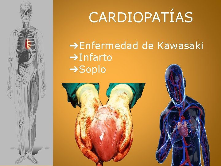 CARDIOPATÍAS ➔Enfermedad de Kawasaki ➔Infarto ➔Soplo 