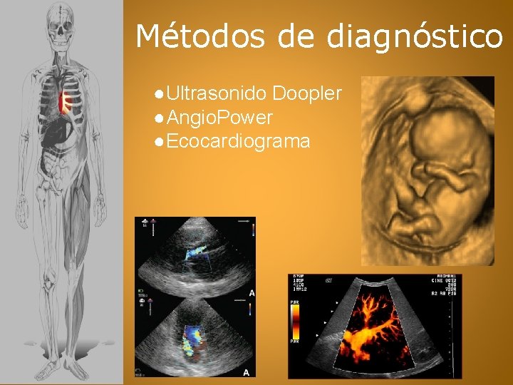 Métodos de diagnóstico ●Ultrasonido Doopler ●Angio. Power ●Ecocardiograma 