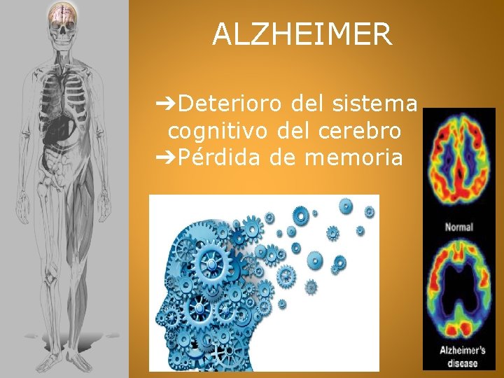 ALZHEIMER ➔Deterioro del sistema cognitivo del cerebro ➔Pérdida de memoria 