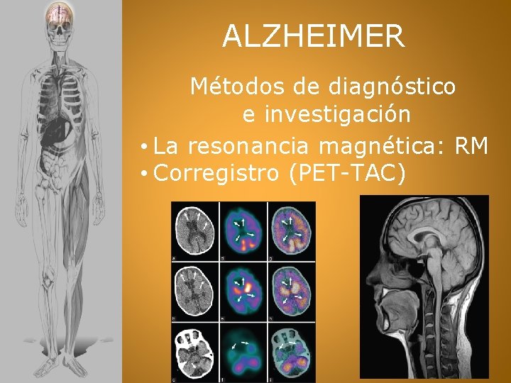 ALZHEIMER Métodos de diagnóstico e investigación • La resonancia magnética: RM • Corregistro (PET-TAC)