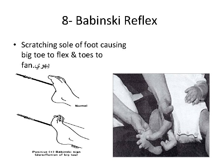 8 - Babinski Reflex • Scratching sole of foot causing big toe to flex