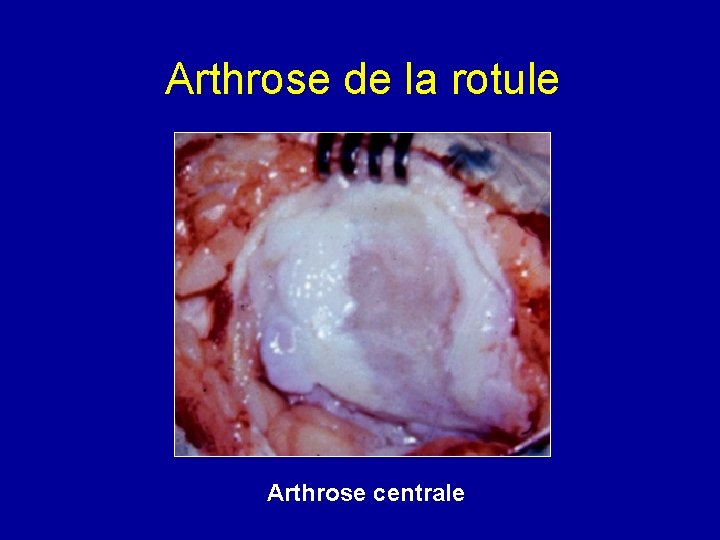 Arthrose de la rotule Arthrose centrale 