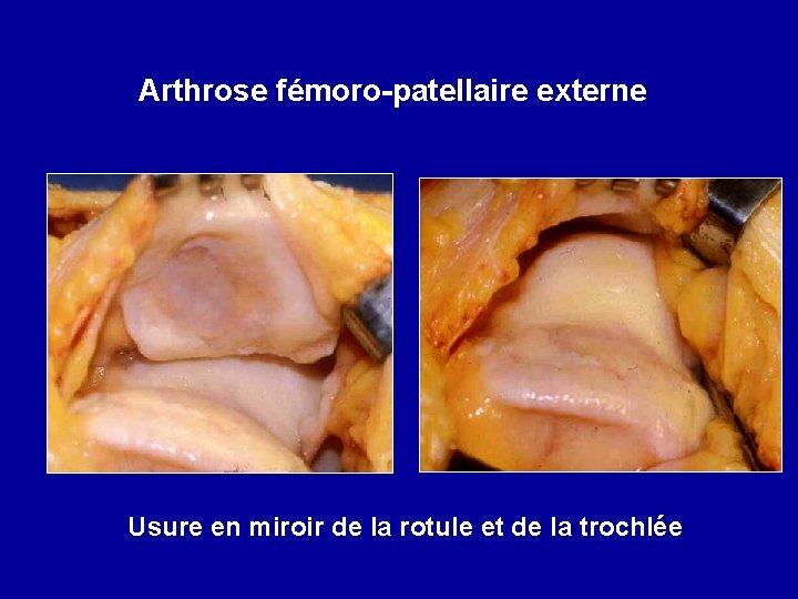 Arthrose fémoro-patellaire externe Usure en miroir de la rotule et de la trochlée 