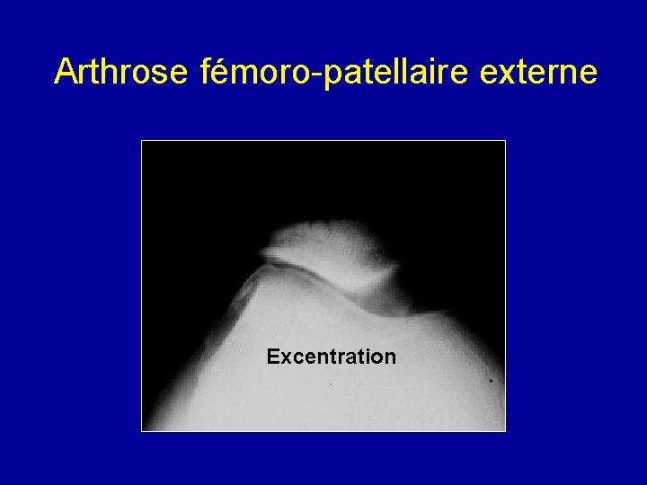 Arthrose fémoro-patellaire externe Excentration 