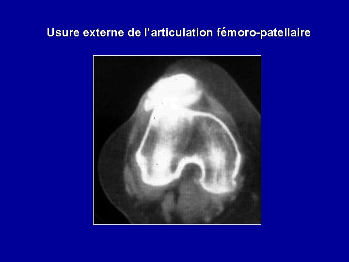 Usure externe de l’articulation fémoro-patellaire 