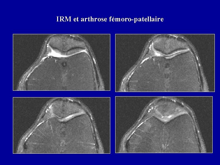 IRM et arthrose fémoro-patellaire 