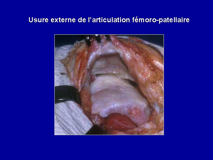 Usure externe de l’articulation fémoro-patellaire 