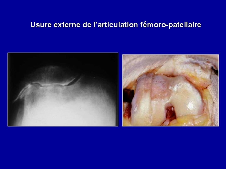 Usure externe de l’articulation fémoro-patellaire 