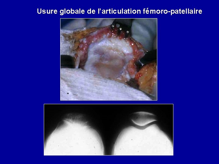 Usure globale de l’articulation fémoro-patellaire 