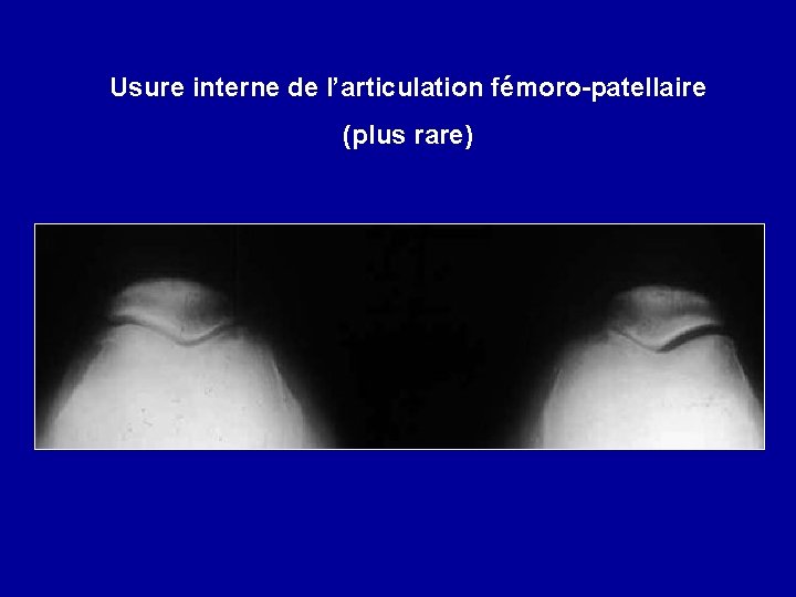 Usure interne de l’articulation fémoro-patellaire (plus rare) 