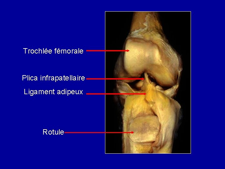 Trochlée fémorale Plica infrapatellaire Ligament adipeux Rotule 