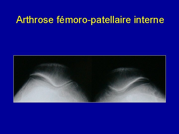 Arthrose fémoro-patellaire interne 