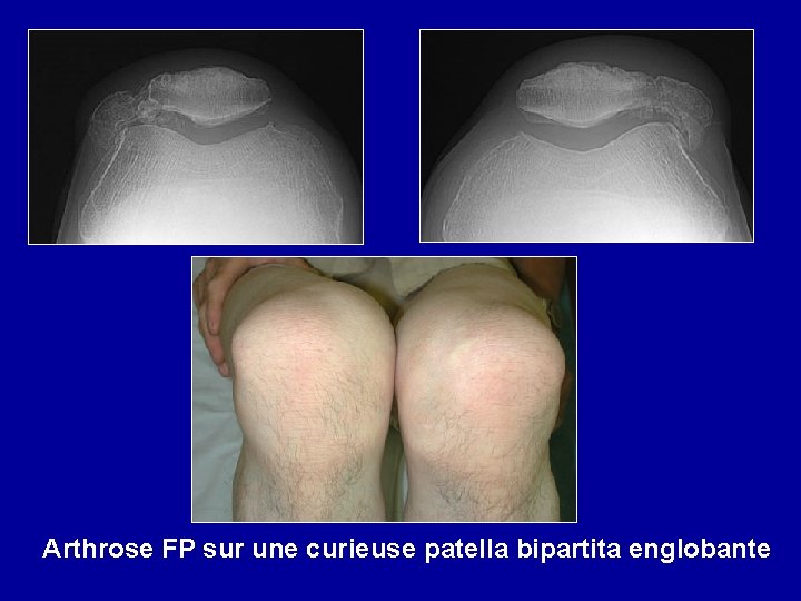 Arthrose FP sur une curieuse patella bipartita englobante 