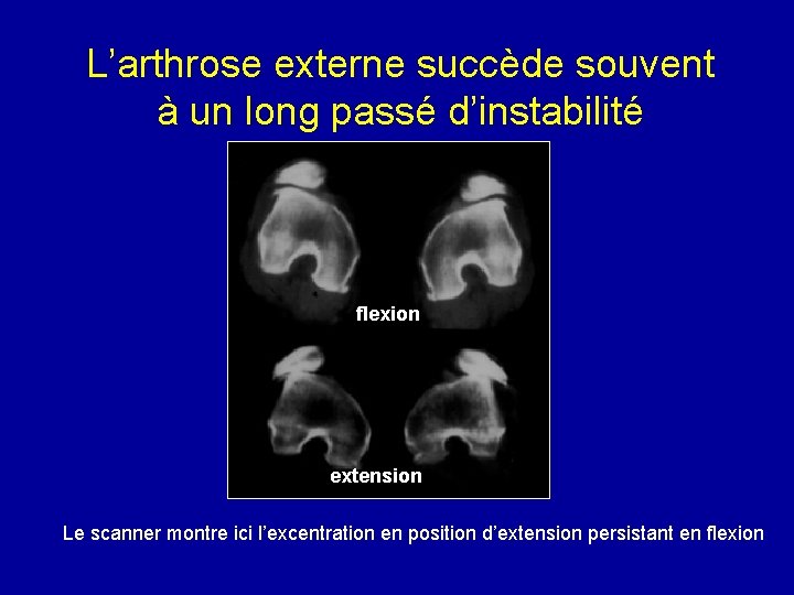 L’arthrose externe succède souvent à un long passé d’instabilité flexion extension Le scanner montre