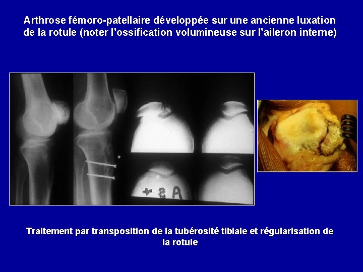 Arthrose fémoro-patellaire développée sur une ancienne luxation de la rotule (noter l’ossification volumineuse sur