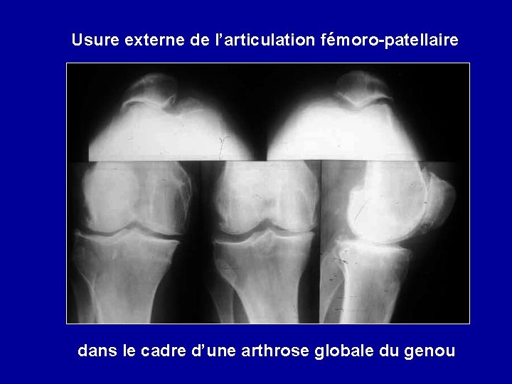 Usure externe de l’articulation fémoro-patellaire dans le cadre d’une arthrose globale du genou 