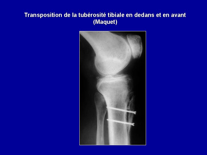 Transposition de la tubérosité tibiale en dedans et en avant (Maquet) 