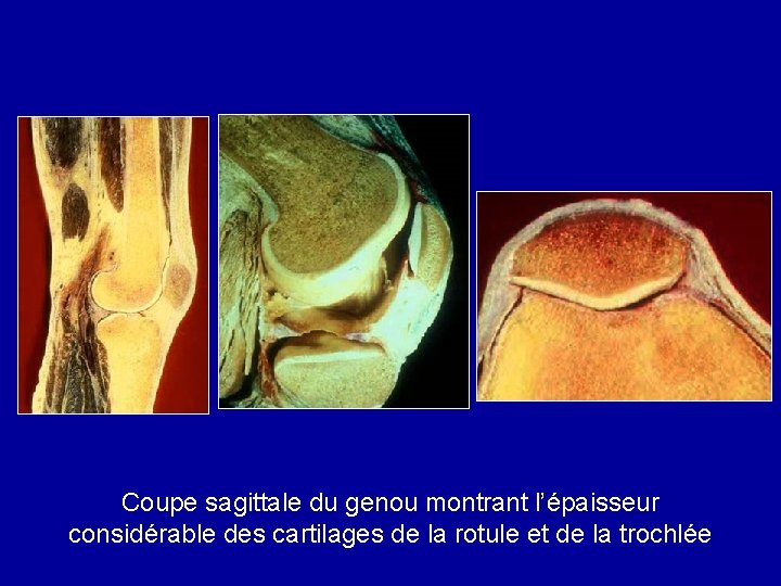 Coupe sagittale du genou montrant l’épaisseur considérable des cartilages de la rotule et de