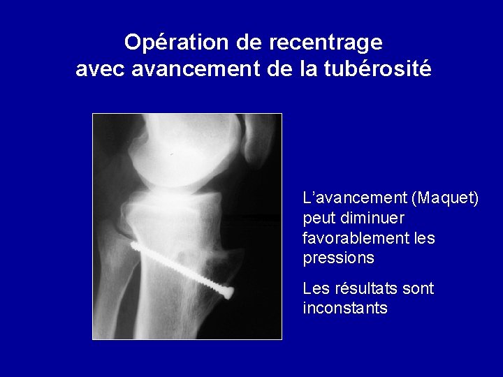 Opération de recentrage avec avancement de la tubérosité L’avancement (Maquet) peut diminuer favorablement les