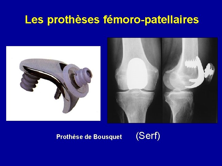 Les prothèses fémoro-patellaires Prothèse de Bousquet (Serf) 