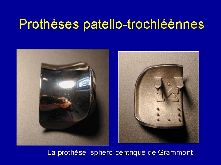 Prothèses patello-trochléènnes La prothèse sphéro-centrique de Grammont 