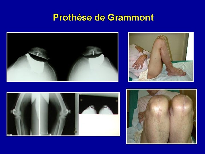 Prothèse de Grammont 