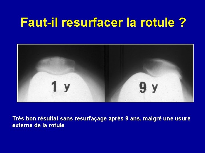 Faut-il resurfacer la rotule ? Très bon résultat sans resurfaçage après 9 ans, malgré