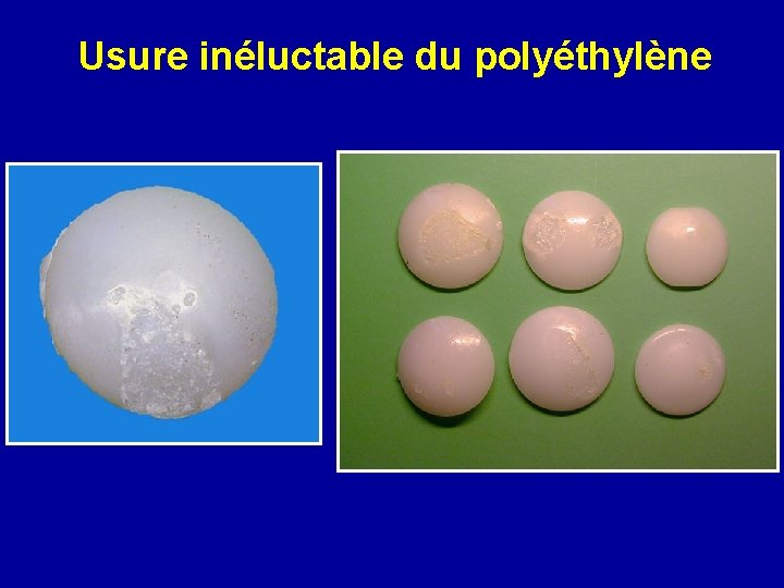 Usure inéluctable du polyéthylène 