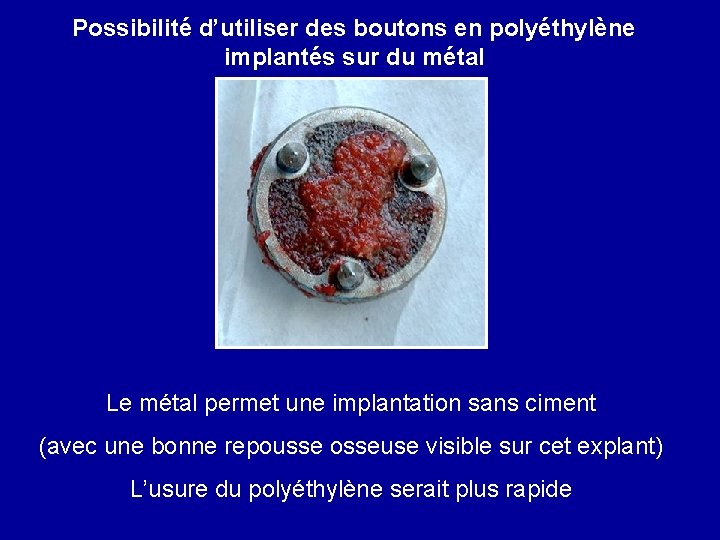 Possibilité d’utiliser des boutons en polyéthylène implantés sur du métal Le métal permet une