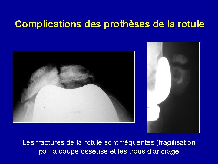 Complications des prothèses de la rotule Les fractures de la rotule sont fréquentes (fragilisation