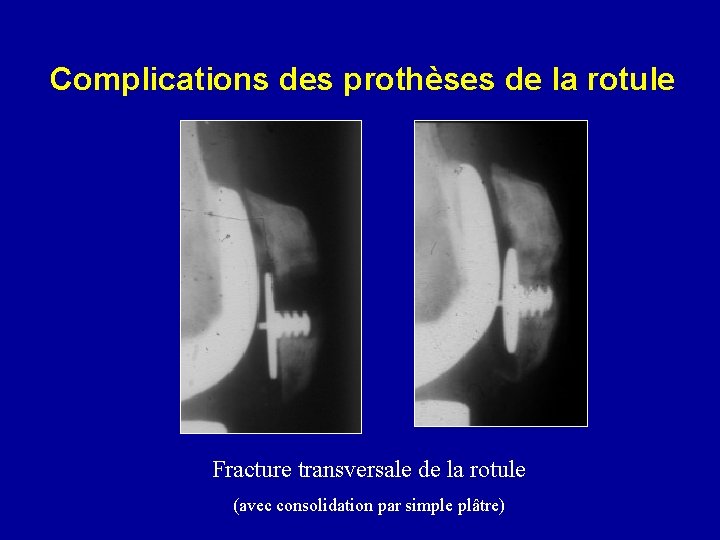 Complications des prothèses de la rotule Fracture transversale de la rotule (avec consolidation par