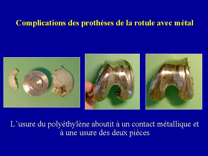 Complications des prothèses de la rotule avec métal L’usure du polyéthylène aboutit à un