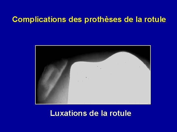 Complications des prothèses de la rotule Luxations de la rotule 