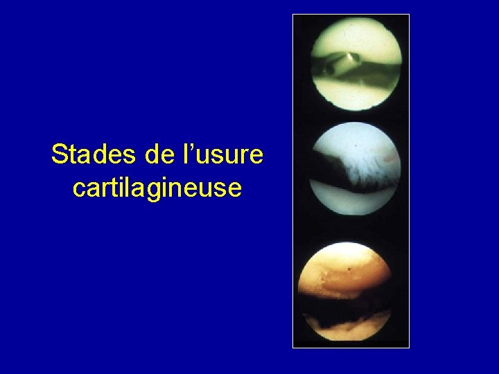Stades de l’usure cartilagineuse 