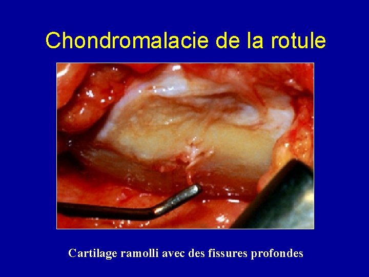 Chondromalacie de la rotule Cartilage ramolli avec des fissures profondes 