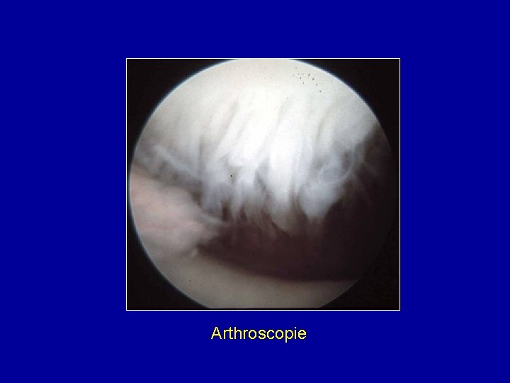 Arthroscopie 