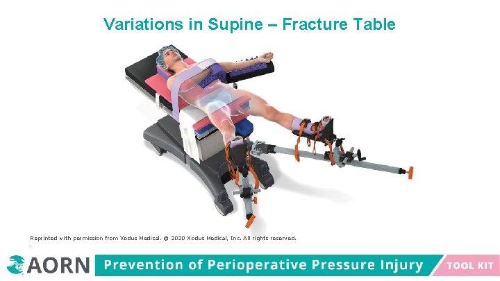 Variations in Supine – Fracture Table Reprinted with permission from Xodus Medical. © 2020