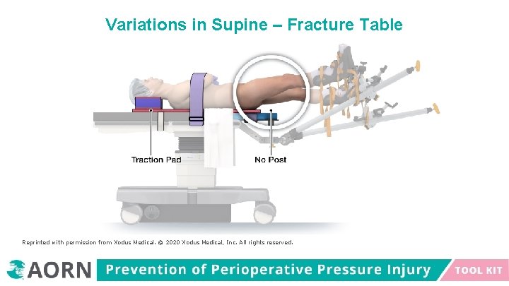 Variations in Supine – Fracture Table Reprinted with permission from Xodus Medical. © 2020