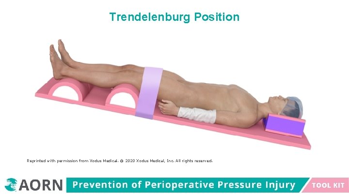 Trendelenburg Position Reprinted with permission from Xodus Medical. © 2020 Xodus Medical, Inc. All