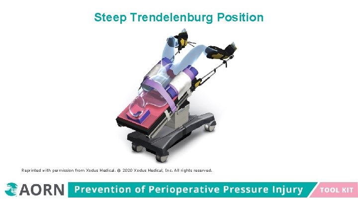 Steep Trendelenburg Position Reprinted with permission from Xodus Medical. © 2020 Xodus Medical, Inc.