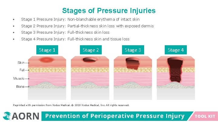 Stages of Pressure Injuries Stage 1 Pressure Injury: Non-blanchable erythema of intact skin Stage