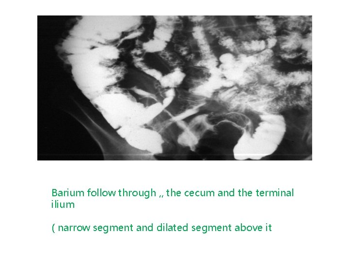 Barium follow through , , the cecum and the terminal ilium ( narrow segment