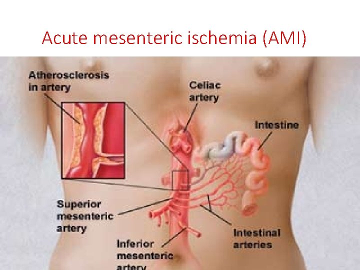 Acute mesenteric ischemia (AMI) 