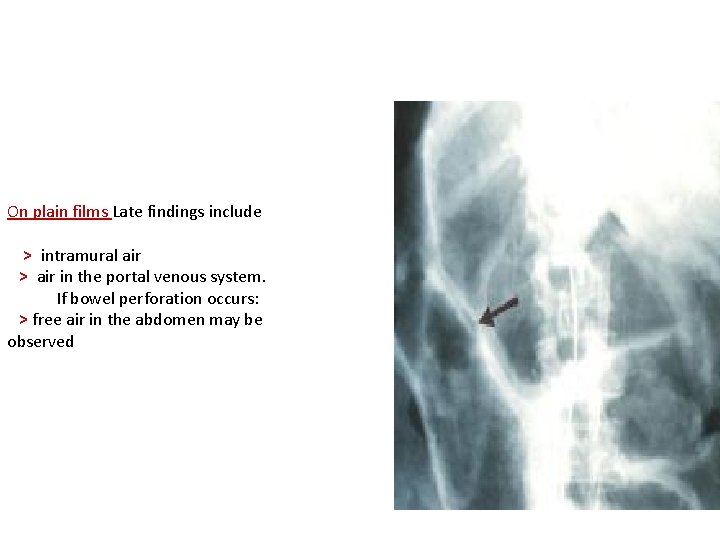 On plain films Late findings include > intramural air > air in the portal
