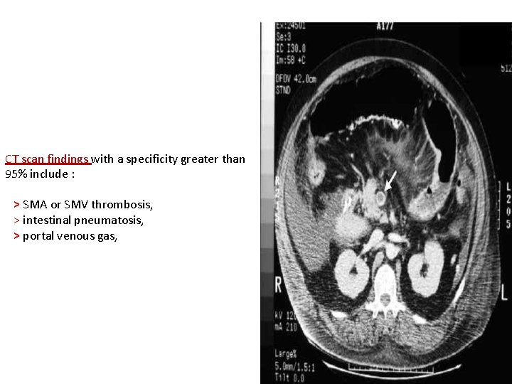 CT scan findings with a specificity greater than 95% include : > SMA or
