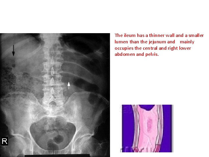 The ileum has a thinner wall and a smaller lumen than the jejunum and