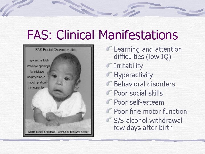 FAS: Clinical Manifestations Learning and attention difficulties (low IQ) Irritability Hyperactivity Behavioral disorders Poor