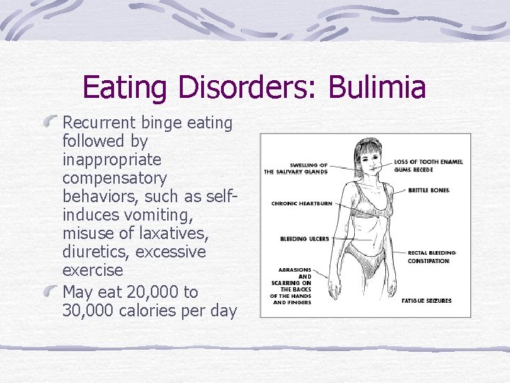 Eating Disorders: Bulimia Recurrent binge eating followed by inappropriate compensatory behaviors, such as selfinduces