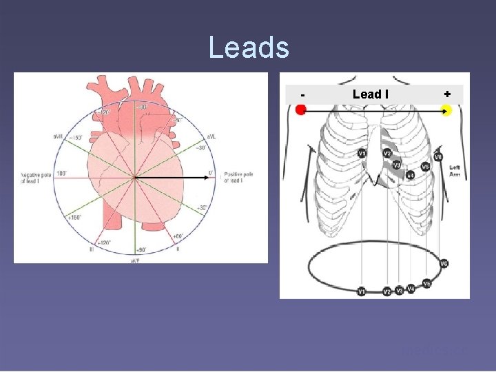 Leads - Lead I + medics. cc 