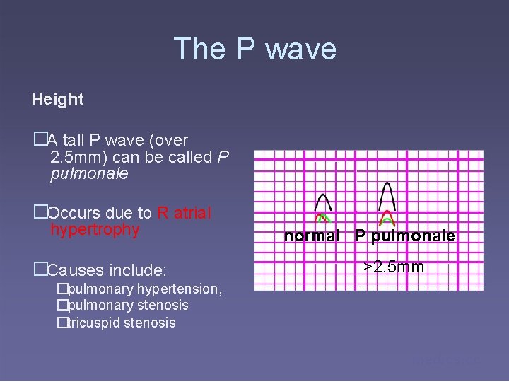 The P wave Height �A tall P wave (over 2. 5 mm) can be